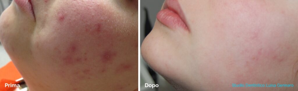 Medicina estetica - peeling chimico al viso